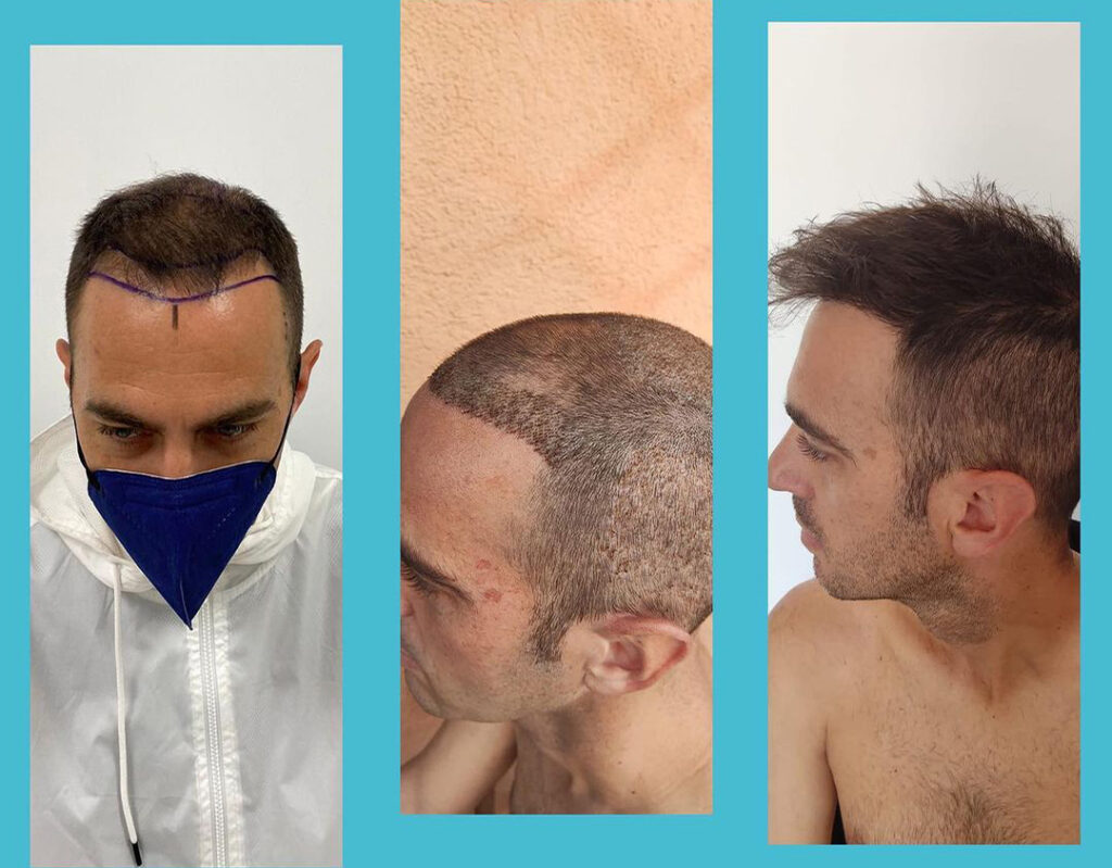 Micro Fue Istanbul - Hair Transplant Istanbul Turkey